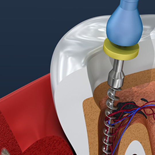 Imagem do procedimento Endodontia